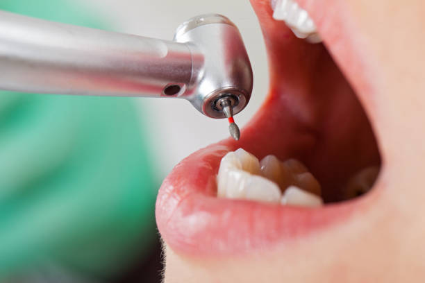 Best Emergency Tooth Extraction in Green Cove Springs, FL